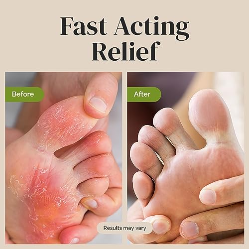 Puriya Tea Tree Oil Antifungal Cream, Plant-Powered Athletes Foot Cream Treatment