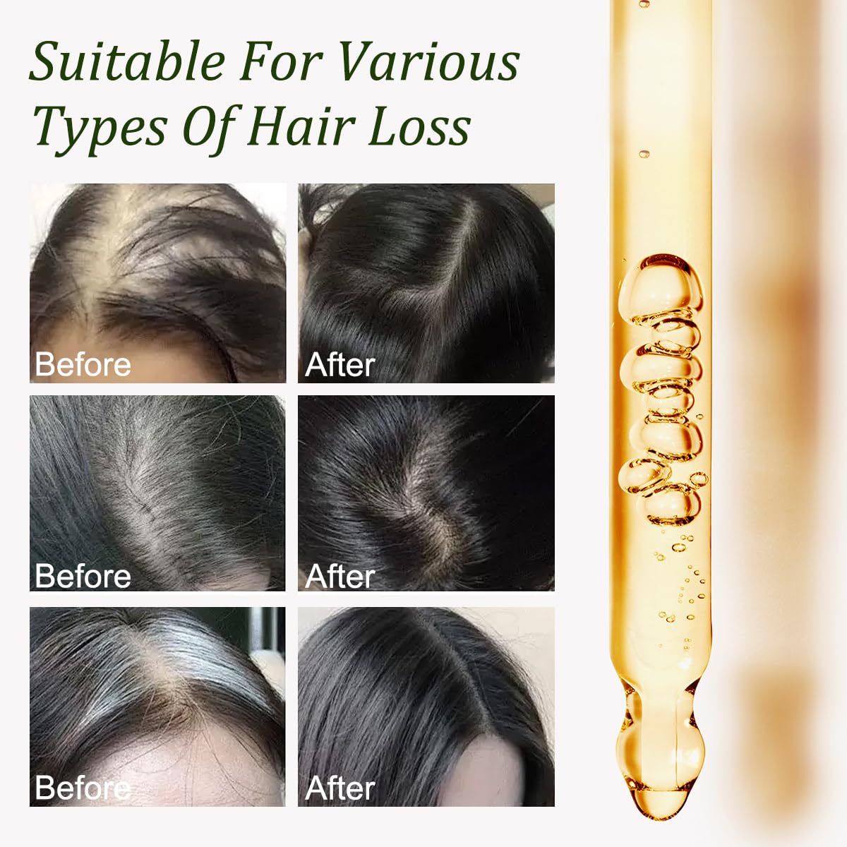 Gypsophila Batana Oil for Hair Growth -100% Pure Natural Hair Growth Oil, Nourishes The Scalp, Eliminates Split Ends, Reduce Hair Loss & Detox Your Scalp (2 Pack) for All Hair Types
