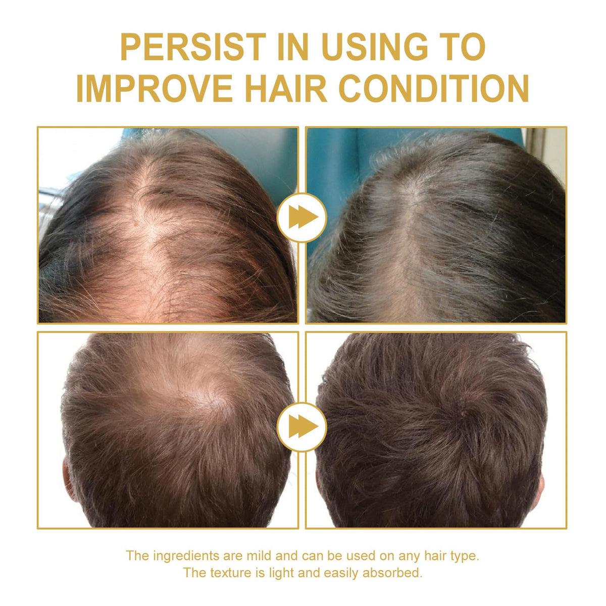 2 Pcs Natural Hair Growth Oil, EELHOE Organic Rosemary Oil for Dry Damaged and Thin Hair.