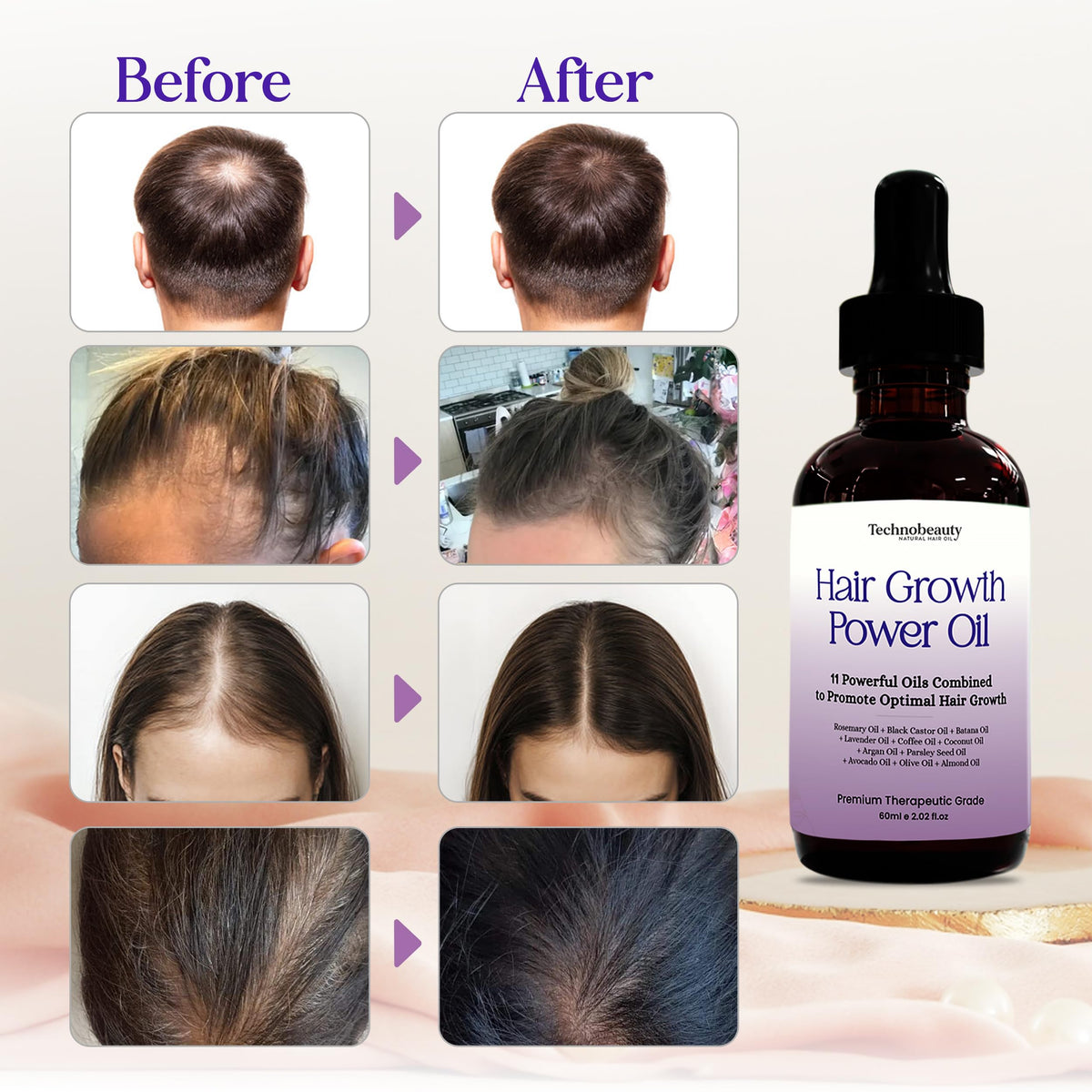 Rosemary Oil With Black Castor, Batana, Lavender, Coffee, Coconut, Argan, Avocado, Olive, Almond & Parsley Seed Oil, 11 Oils Infused for Ultimate Hair Growth & Care for Stronger, Thicker Hair