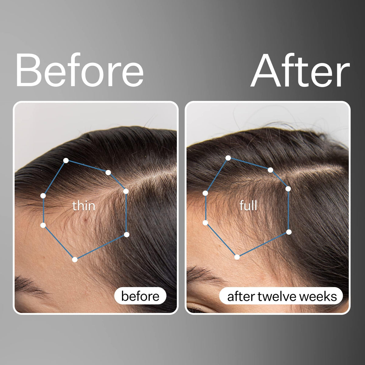 Act+ Acre Cold Processed Stem Cell Scalp Serum - For Thicker, Fuller Looking Hair - Apple Stem Cells, Bamboo Extract, Aloe Vera - Strengthen, Hydrate, Reduce Shedding - Vegan, Color Safe - 1 fl oz.